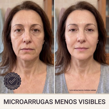 Microarrugas menos visibles