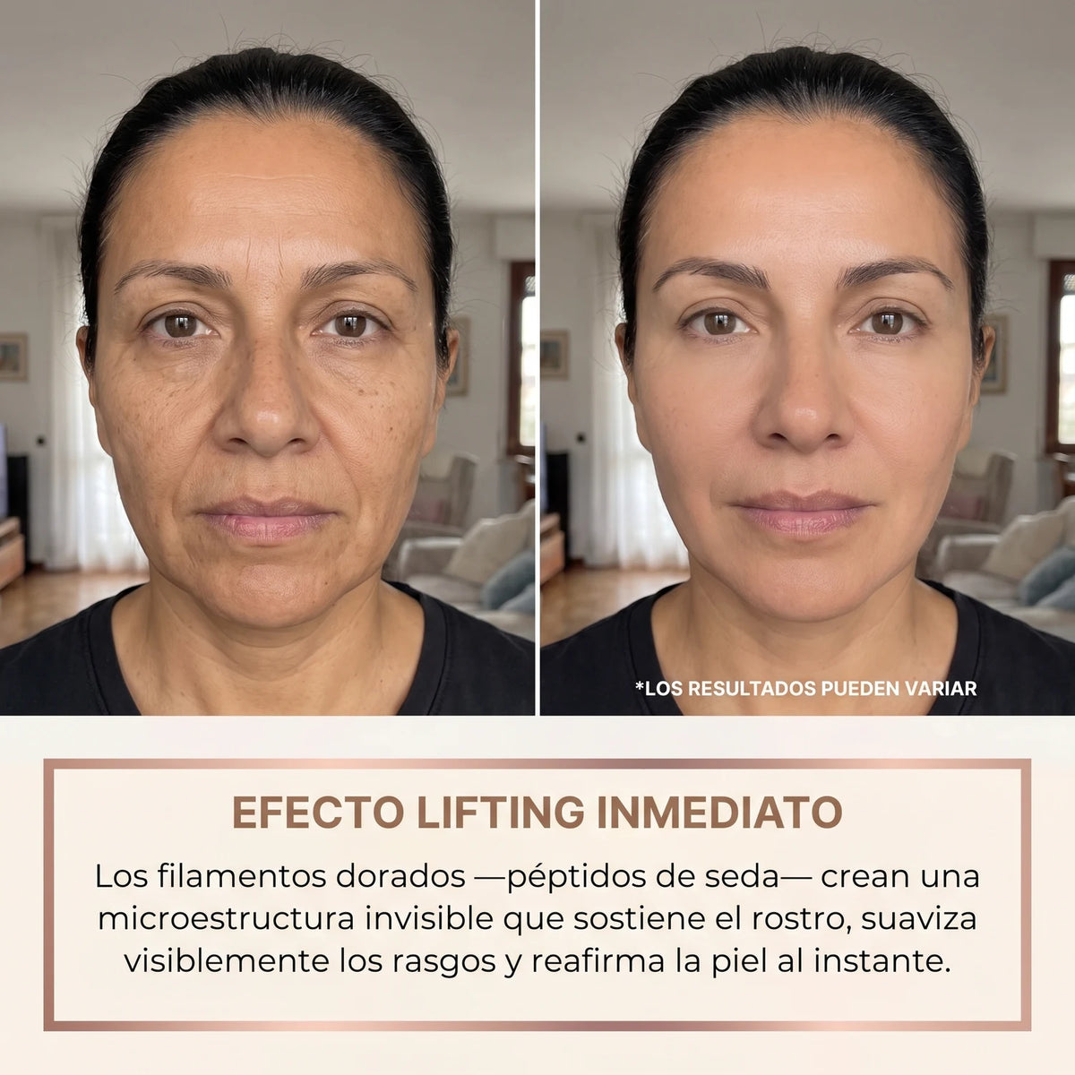 Efecto lifting inmediato antes y después