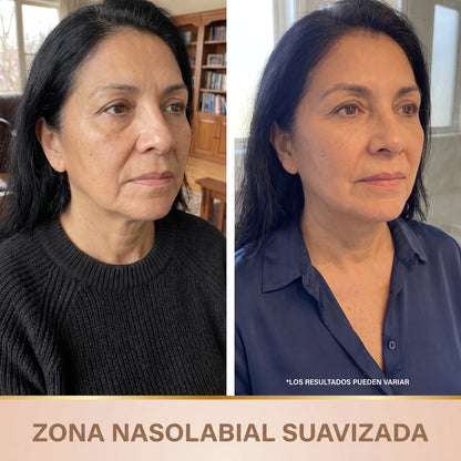 Zona nasolabial suavizada